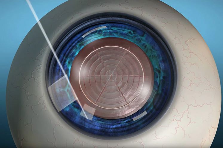 laser cataract surgery graphic