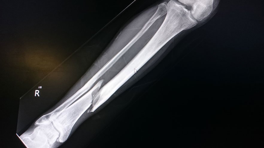 bone fracture