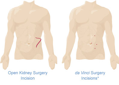 kidney anatomy open vs davinci