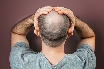 male pattern baldness