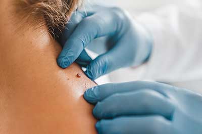 dermatologist looking at mole
