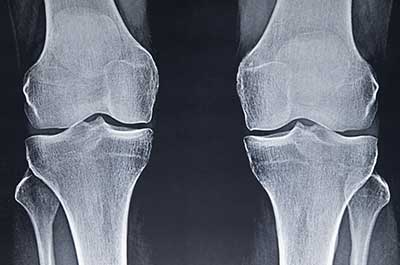 xray of osteoarthritis