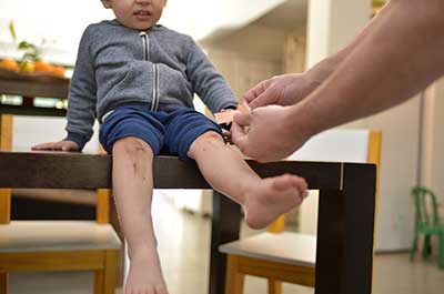 treating minor wounds
