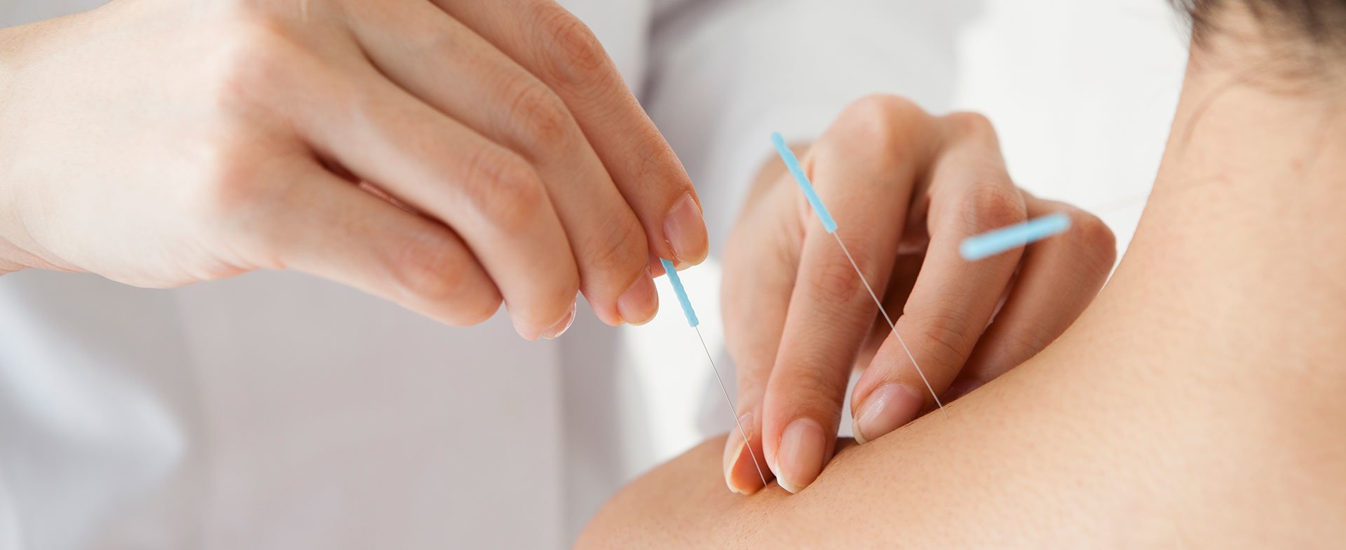 acupuncture for anxiety