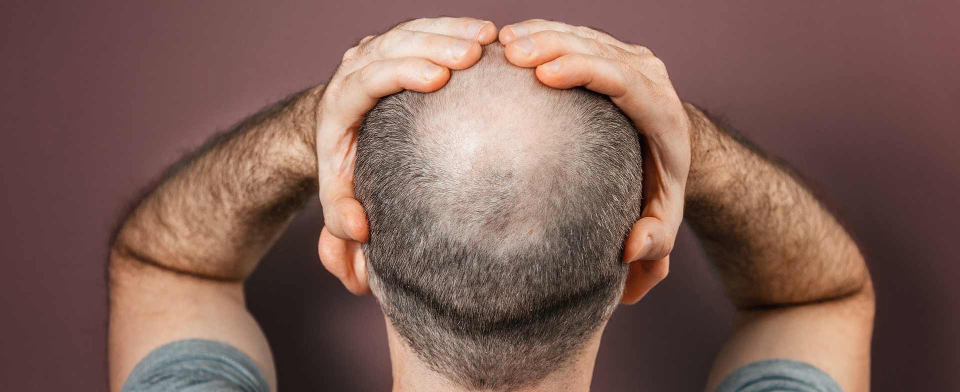 male pattern baldness