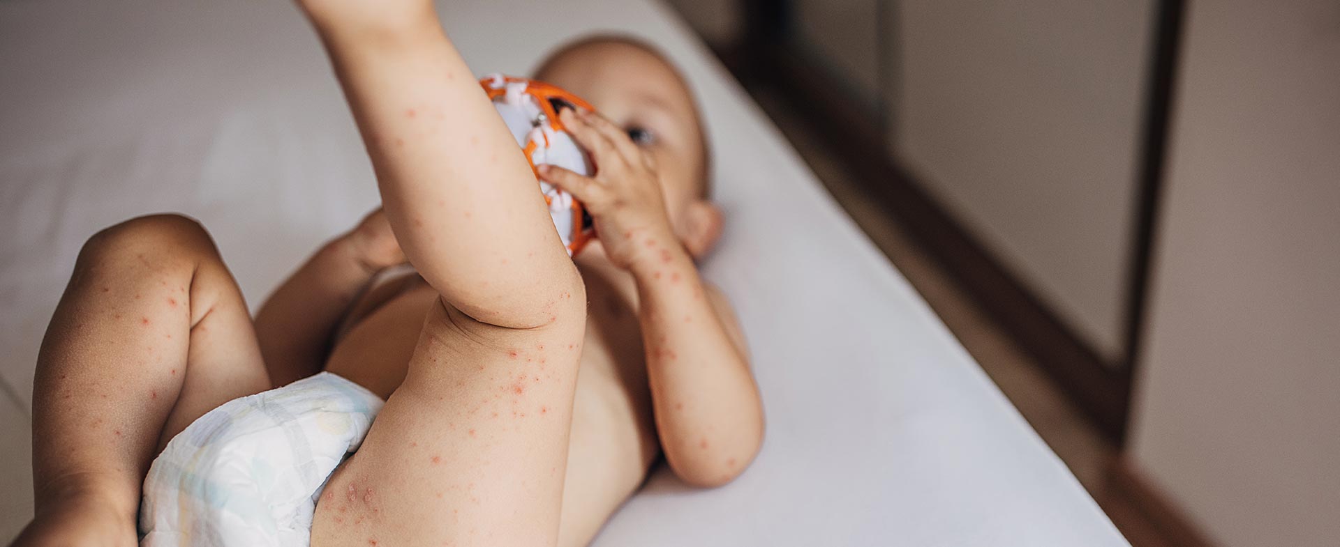 hand food mouth disease