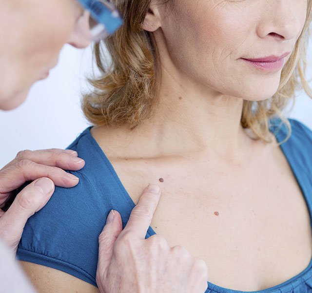 skin cancer screening 1