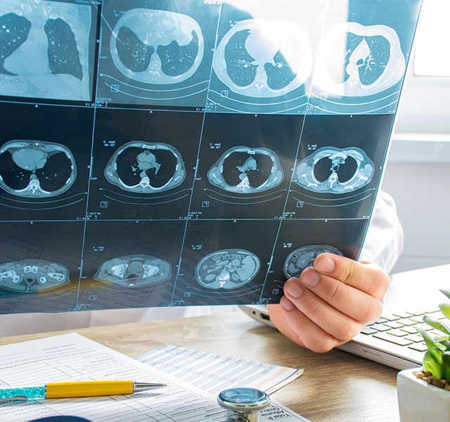 lung cancer screening