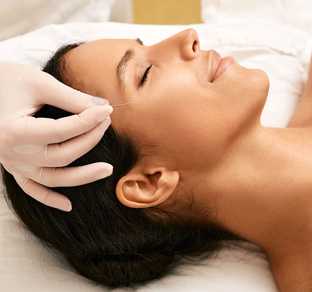 A person receiving facial acupuncture, lying on a treatment table with closed eyes. A gloved hand is carefully placing a thin needle on the person's cheekbone. cosmetic acupuncture