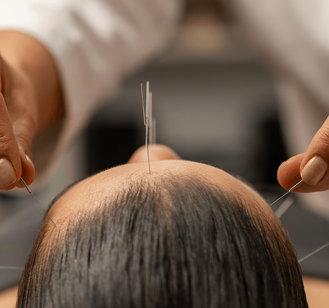 Close up image of acupuncturist placing needles on woman's head and forehead. dummy mobile image