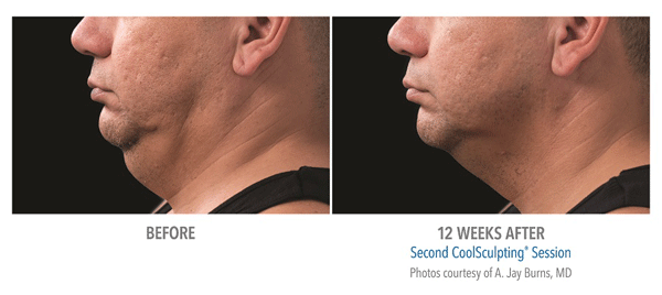 facial coolsculpting patient