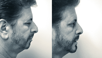 deeb rhinoplasty chinimplant