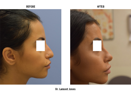 Side profile of woman before and after rhinoplasty