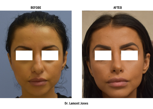 Dr Jones Before and After Patient 3