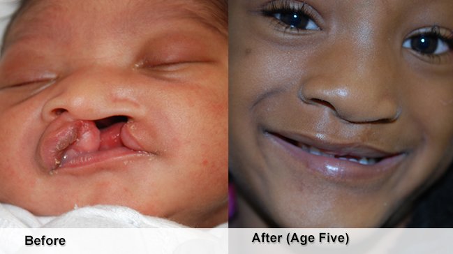 Before and after cleft lip and palate on baby and child