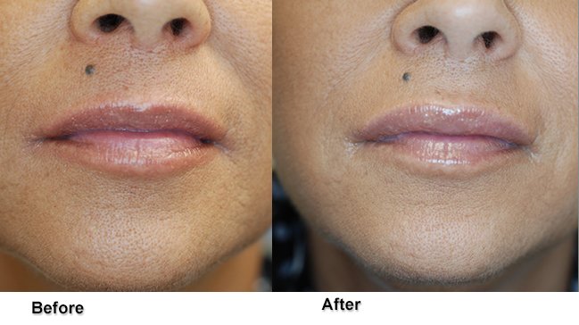 jones lipenhancement 2