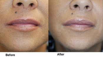 jones lipenhancement 2