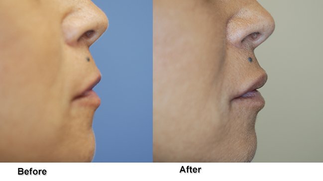 Before and after lip enhancement surgery