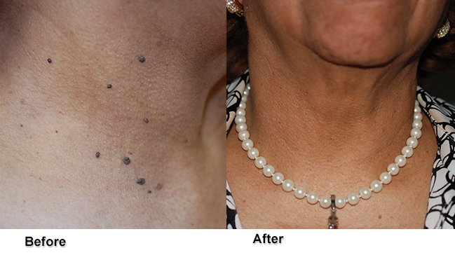 Before and after mole removal surgery on neck