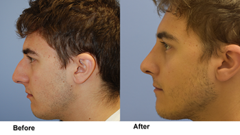 jones rhinoplasty 1