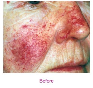 vbeam before photo 3