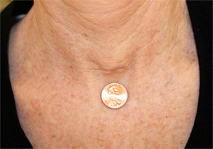 Picture of a woman’s throat with a coin to show the size of her minimally invasive scar from a thyroidectomy performed at Henry Ford Health a week after the surgery.