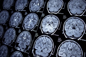 Frontotemporal Dementia